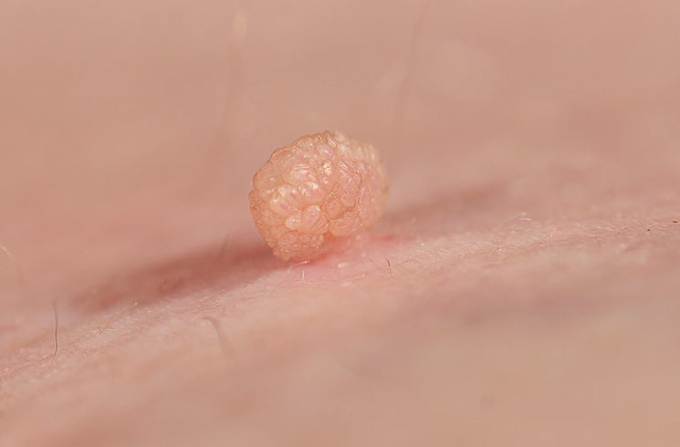 skin tag removal nz