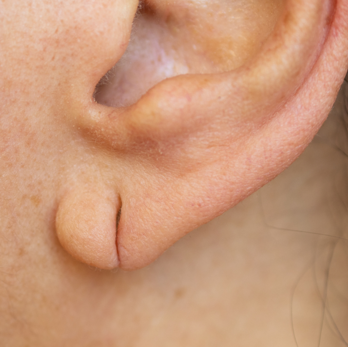 split earlobe repair nz