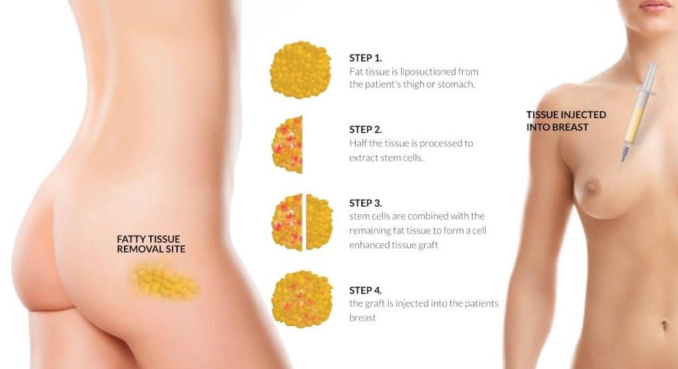 Why would you have fat transfer to breast?