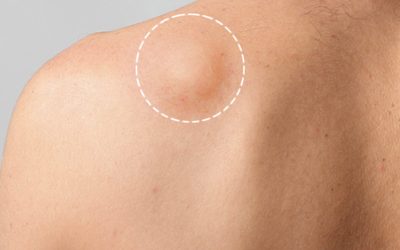 How to decide of Lipoma Removal is right for you?