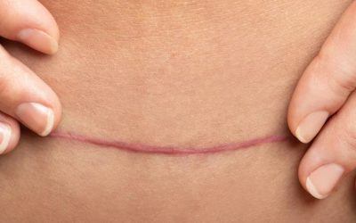 Understanding scar discoloration after plastic surgery