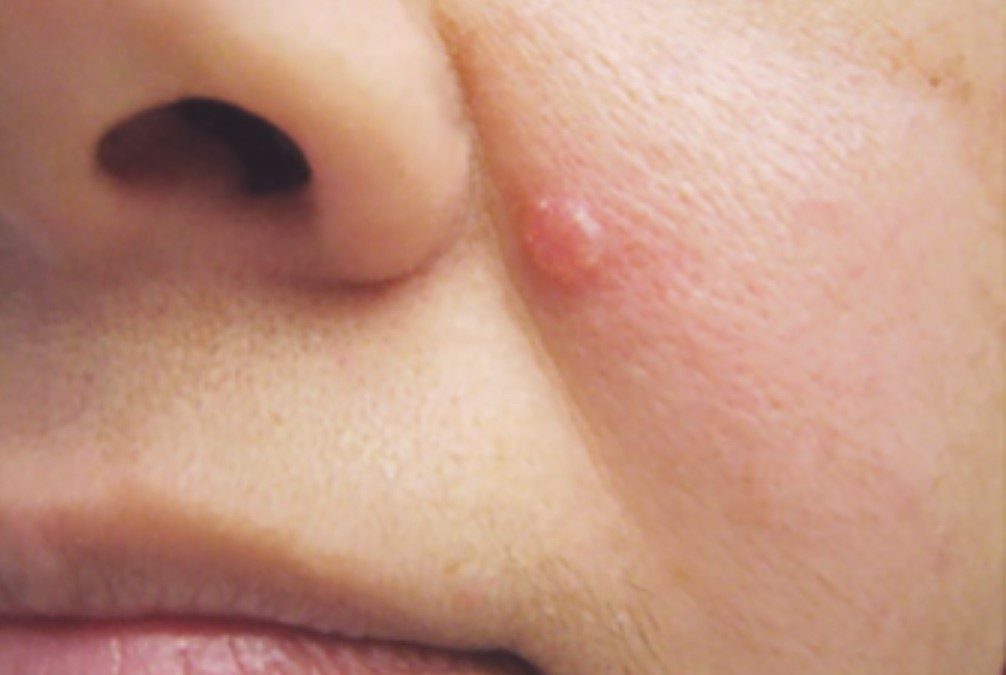 The 6 main types of basal cell carcinoma and how they differ
