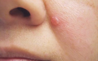 The 6 main types of basal cell carcinoma and how they differ
