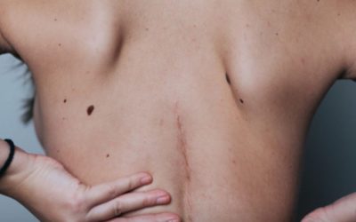 What determines a good scar after plastic surgery?