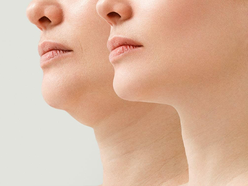chin liposuction