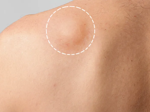 lipoma removal