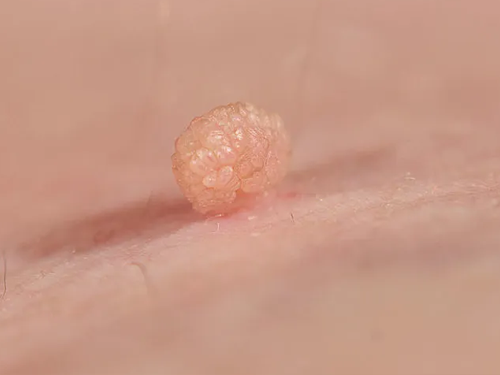skin tag removal