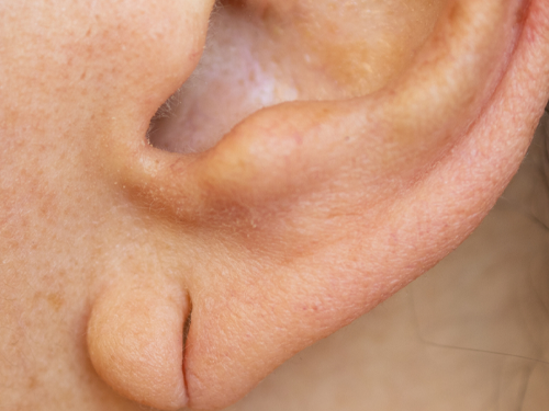 split earlobe repair