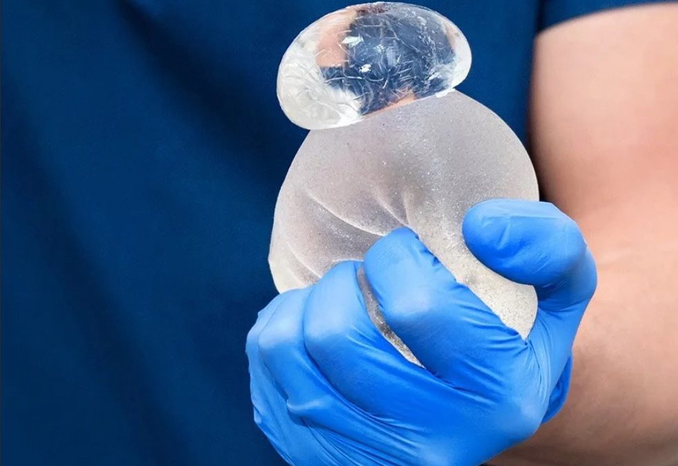Ruptured breast implant
