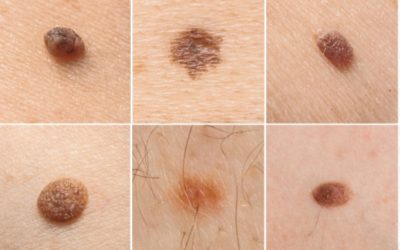 How to Spot Unusual Moles?