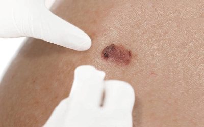 Understanding complex skin cancers