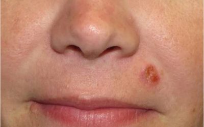 Understanding Squamous cell Carcinoma