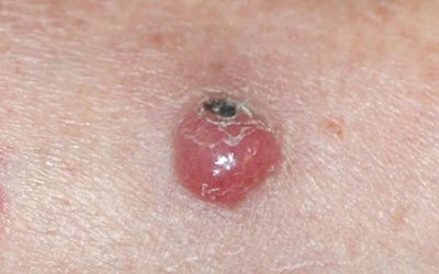 Rare Skin Cancers: Merkel Cell Carcinoma