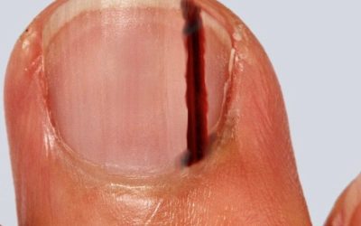 Nail (Subungual) Melanoma: What to Look For, Why It’s Missed, and Why Early Investigation Matters