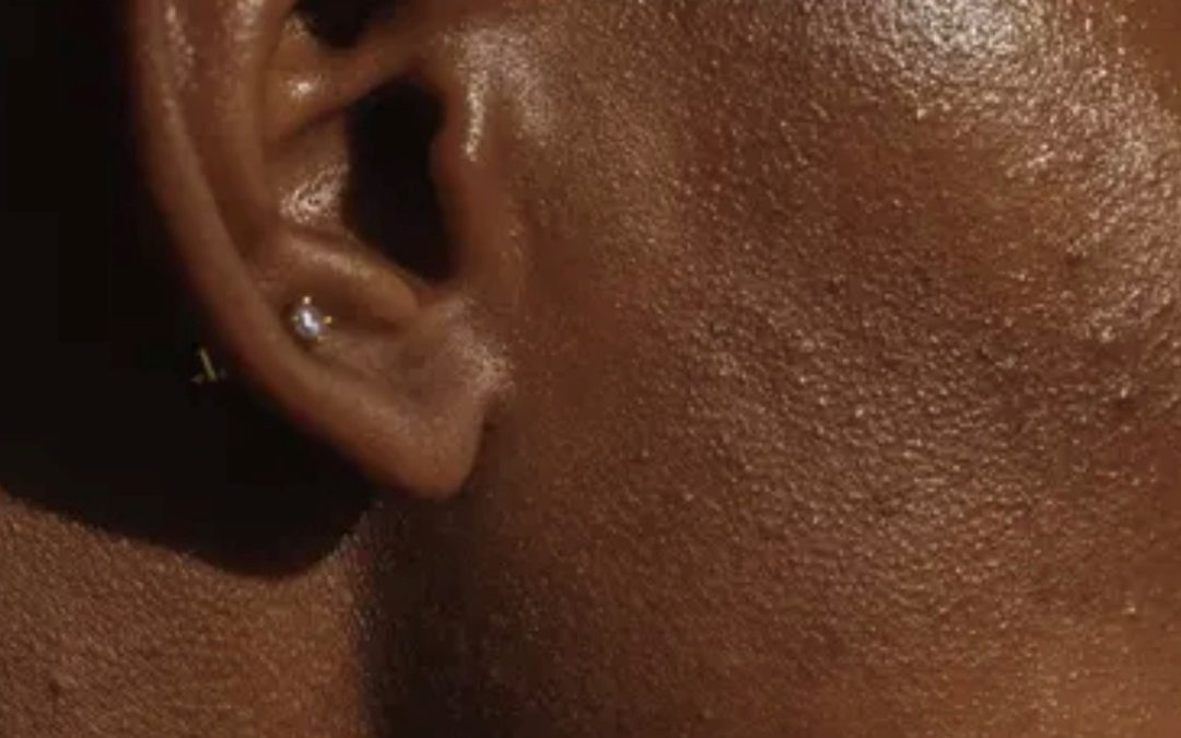 Skin Cancer in Skin of Colour