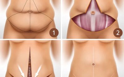 Fleur-de-Lis Tummy Tuck (Abdominoplasty) Explained