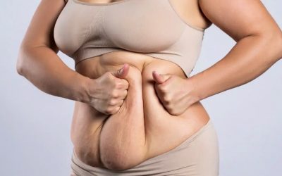 Mini Tummy Tuck vs Full Tummy Tuck-Which Is Right For You