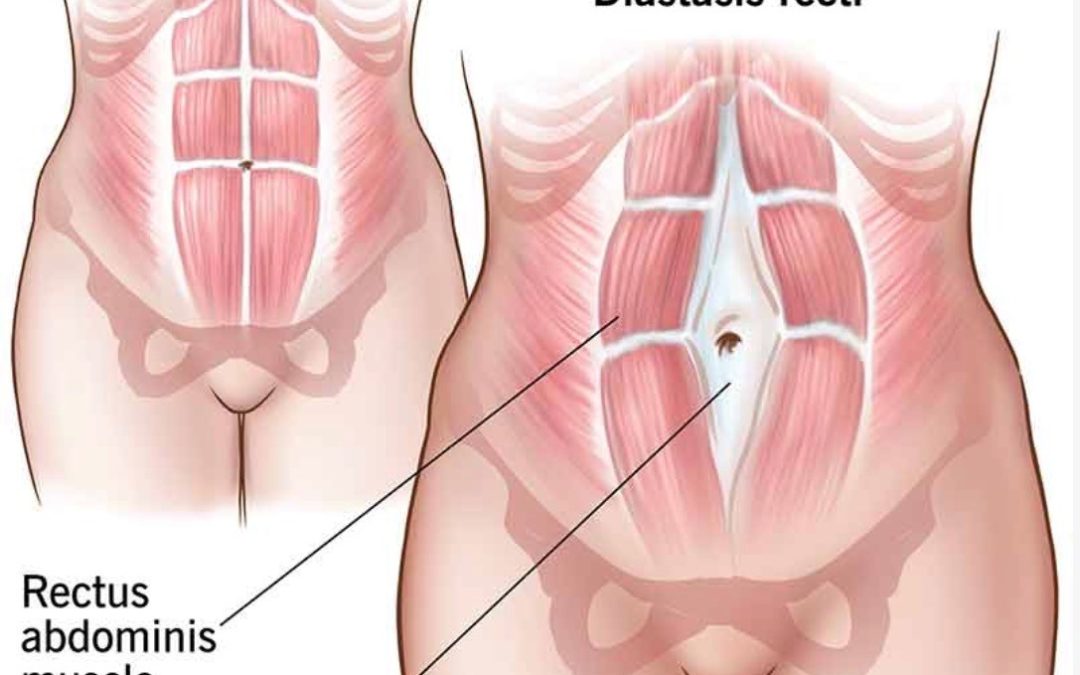Diastasis recti: split tummy muscles after pregnancy